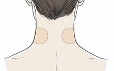 Bé gái 7 tuổi loạn thần cấp tính sau khi dùng miếng dán chống say tàu xe