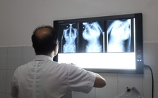 Nhận biết sớm dấu hiệu bệnh cong vẹo cột sống ở trẻ em