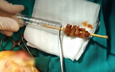 Cấp cứu bé gái 2 tuổi rưỡi bị que xiên thịt đâm sâu đến hốc mắt