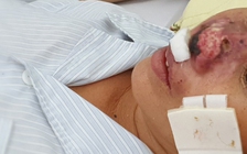 Bệnh 'sốt đất' dễ bị chẩn đoán nhầm và diễn biến nặng