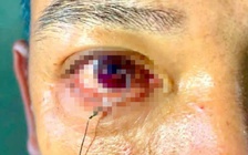 Cấp cứu bệnh nhân bị lưỡi câu ghim vào mắt