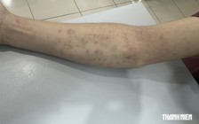 Trị tận gốc viêm da mùa nắng nóng