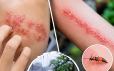 Nổi mụn nước, bỏng rát trên da: Làm sao biết do zona hay kiến ba khoang?
