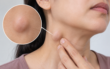 3 điều cần biết khi xuất hiện hạch ở cổ
