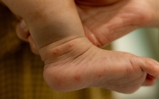 Đầu năm học, cảnh báo gia tăng bệnh ở trẻ nhỏ