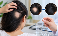 Rụng tóc từng mảng: Hơn 50% mọc lại tóc sau 24 tuần dùng thuốc