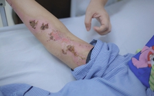 Bất ngờ bị sét đánh trên đường về nhà, người phụ nữ bỏng nặng