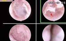 Bọ chét 'làm tổ' trên người: Dấu hiệu và cách phòng tránh
