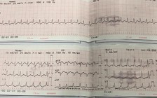 Sốc điện 2 lần để cứu cụ ông nhịp tim nhanh kịch phát trên thất