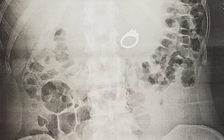 Cô gái nuốt nhẫn đính hôn vì mơ thấy kẻ xấu