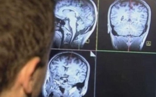Dùng trí tuệ nhân tạo chẩn đoán chứng mất trí nhớ