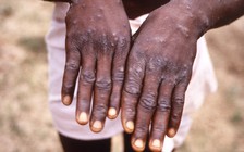 WHO không tin đậu mùa khỉ sẽ gây đại dịch