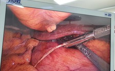 Tưởng sỏi mật, gan nhiễm mỡ hóa ra xương cá đâm thủng dạ dày mưng mủ