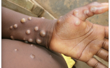 Bệnh đậu mùa khỉ có thể để lại di chứng nặng nề