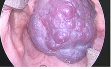 Cứu bệnh nhân Campuchia bị khối u máu chiếm toàn bộ thanh quản hiếm gặp