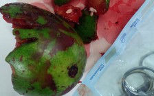 Cụ ông nhập viện với quả bí đao mắc kẹt trong hậu môn