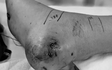 Tự ý đắp lá vào vết rắn cắn, bé trai bị nhiễm trùng nặng