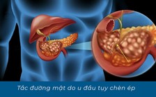 Thông tắc ống mật cho người phụ nữ bị 2 khối u chèn ép