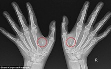 Trào lưu cấy chíp làm... siêu nhân