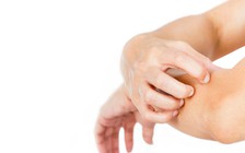 5 cách ngừa chàm, vẩy nến tái phát