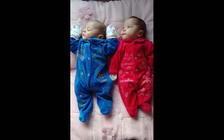 Duy trì người mẹ chết não để cứu song thai