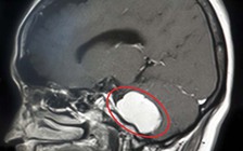 Lấy ra khối u to như quả bóng bàn trong não bệnh nhân