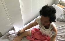 Bị bỏng nặng do kẻ xấu ném chai xăng vào nhà lúc gần nửa đêm