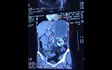 Mang trong bụng khối u 2 kg mà tưởng là đau dạ dày