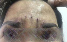 Bị biến dạng mặt vì treo chân mày bằng chỉ