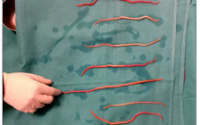 Bác sĩ cũng sốc khi lấy 14 con giun đũa ra khỏi ống mật một phụ nữ