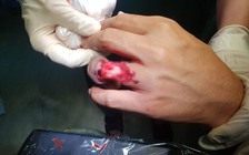 Suýt mất ngón tay vì... đeo nhẫn