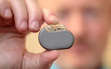 Kích thích dây thần kinh giúp điều trị hiệu quả trầm cảm