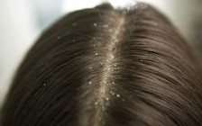 3 nguyên nhân gây ra gàu khiến bạn bất ngờ