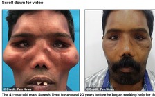 Người sống chung với 'khuôn mặt sư tử' suốt 20 năm