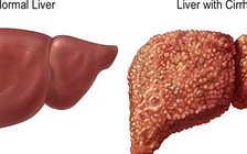 Xơ gan không phải lúc nào cũng do rượu