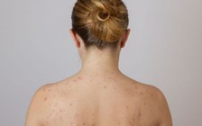 Mẹo chữa viêm lỗ chân lông tại nhà hiệu quả