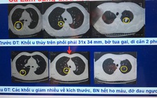 BV Bạch Mai điều trị hiệu quả ung thư di căn bằng phương pháp mới