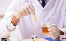 Xét nghiệm nước tiểu: Bước tiến mới trong chẩn đoán ung thư tuyến tiền liệt