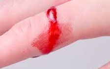 Biến chứng bệnh rối loạn đông máu và cách điều trị