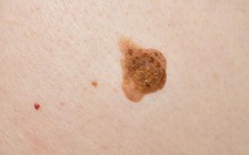 Vì sao không bao giờ được bỏ qua nốt ruồi xuất hiện sau tuổi 40?