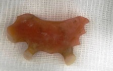 Gắp răng giả ra khỏi thực quản người phụ nữ