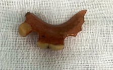 Lấy hàm răng giả ra khỏi... thực quản của bệnh nhân