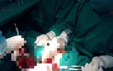 Rơi từ độ cao hơn 3 mét, người phụ nữ bị cây gỗ mục đâm thủng đùi