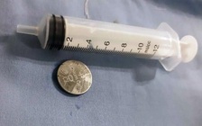 Gắp ra viên pin trong dạ dày bé gái 16 tháng tuổi