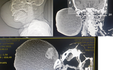 Cắt bỏ khối u tuyến mang tai 2 kg cho cụ bà 95 tuổi