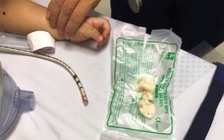 Cứu bé trai bị ngưng tim, ngưng thở do hóc thạch rau câu