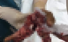 Điện thoại phát nổ khi vừa sạc vừa sử dụng, một thanh niên bị dập bàn tay