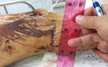 Hé lộ manh mối vụ chấn động tạt a xít, cắt gân chân Việt kiều Canada