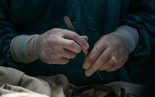 Bác sĩ cũng sốc: Lấy 122 cây đinh ra khỏi dạ dày bệnh nhân