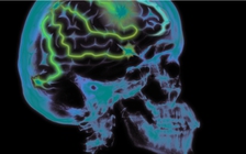 Căng thẳng quá nhiều có thể dẫn đến teo não